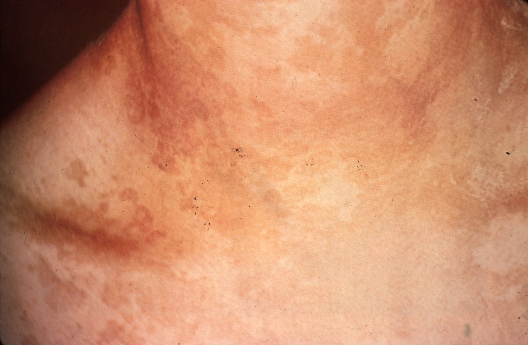 Tinea Versicolor: Cause, Symptoms, and Treatments - WebMD