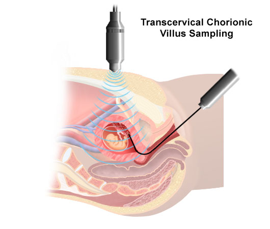 Illustration demonstrating a transcervical chorionic villus sampling